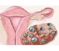 Polycystic ovary syndrome in every day practice