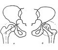 Варианты строения вертлужной впадины  и виды диспластической децентрации  головки бедренной коcти во фронтальной плоскости