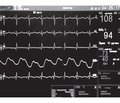 Tachyarrhythmia in neonates.  Clinical case of atrial flutter in a newborn