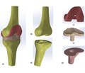 Біомеханічний аналіз умов функціонування ендопротеза колінного суглоба  при варусних деформаціях кінцівки  у хворих на ревматоїдний артрит