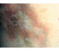 Juvenile localized scleroderma: clinical picture, diagnosis, therapeutic update  (literature review and own observations)