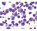 Intraoperative cytology as an additional method for detecting papillary thyroid carcinoma