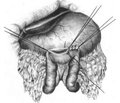 A clinical case of gastroenterostomy with Braun anastomosis under epidural anesthesia