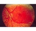 Influence of VEGFA gene polymorphisms rs2010963 and rs699947 on clinical and laboratory indicators in diabetic retinopathy among patients with type 2 diabetes mellitus