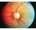 An analysis of the effectiveness of Travinor®in the treatment of primary open-angle glaucoma