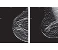 Modern methods of medical imaging in the diagnosis and screening of breast cancer