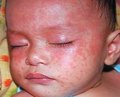 Measles in children