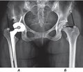 Selection of endoprosthetic components  and value of general femoral offset after hip replacement  (X-ray study)