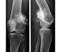 Оцінка ефективності та ускладнень неоад’ювантної поліхіміотерапії  у комбінованому лікуванні хворих  на остеосаркому довгих трубчастих кісток