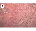 State of IgG4-positive plasma cells in the colon mucosa of chronic inflammatory bowel disease