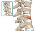 Clinical features and treatment of non-complicated thoracic spine hemangiomas