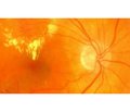Disturbed platelet aggregation as a factor of diabetic maculopathy and diabetic macular edema in patients with nonproliferative diabetic retinopathy in type 2 diabetes mellitus