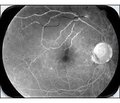Peculiarities of peripapillary neuronal changes in patients with axial diabetic optic neuropathy depending on the stage of the disease