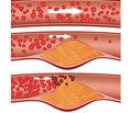 Diabetes mellitus and atherosclerosis. The role of inflammatory processes in pathogenesis (literature review)