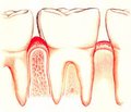 Application of the treatment and preventive measures for caries and gingivitis in school-age children