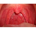 Clinical experience of Streptococcus salivarius K12 use for the prevention of pharyngotonsillitis  and respiratory infections in children