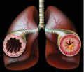Prediction of the severe course of bronchial asthma in children