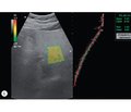 Age features of liver status in patients with chronic inflammatory bowel diseases according to steatometry and shear wave elastography
