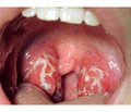 Clinical and immunological efficacy of Streptococcus salivarius K12 in the prevention of exacerbations and the treatment of chronic tonsillitis in children
