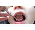 Визначення передумов  для реалізації регіональних програм профілактики карієсу зубів  на території Закарпатської області
