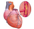 Фактори, з якими асоціюється регрес ураження органів-мішеней на фоні терапії фіксованою комбінацією периндоприлу/амлодипіну в гіпертензивних пацієнтів залежно від наявності ішемічної хвороби серця