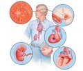 Influence of certain components of metabolic syndrome on renal function in hypothyroidism (literature review)