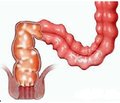 Peculiarities of the course of ulcerative colitis in children at the present stage