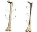 The study of the stress-strain state in the “implant-bone” system on the model  of the allocomposite endoprosthesis of the proximal femur