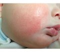 Efficiency of allergen specific immunotherapy in children with atopic dermatitis combined  with the pathology of the upper gastrointestinal tract
