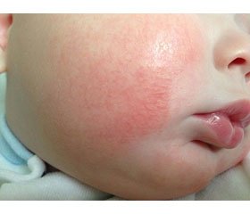 Ефективність застосування методу алергенспецифічної імунотерапії в дітей з атопічним дерматитом  у поєднанні з патологією верхніх відділів  шлунково-кишкового тракту