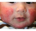 Optimizing treatment of atopic dermatitis in infants using  ursodeoxycholic acid