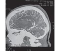 Clinical case of hemorrhagic stroke in pregnant woman as a result of ruptured cerebral arteriovenous malformation