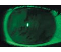 Fixed combination of hyaluronic acid and dexpanthenol in improving the state of the front surface of the eye after cataract surgery
