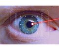 Результати корекції рогівкового астигматизму при факоемульсифікації катаракти з імплантацією торичної інтраокулярної лінзи та за програмою «Біоптика»