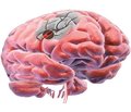 Патогенетическое лечение хронической церебральной ишемии: в фокусе цитофлавин