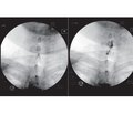 Epidural infiltration of glucocorticoids and local anesthetics in the treatment of non-specific back pain