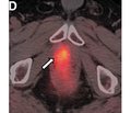 Multimodal imaging of prostate cancer