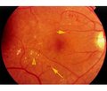 Glycated proteins, oxidative stress, interleukins: risk factors for the occurrence and progression of diabetic retinopathy