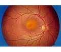 Prediction of age-related macular degeneration basedon the definition of platelet receptors functional activity 