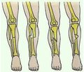 Bone mineral density and vitamin D level in persons of different age with lower limb fractures (literature review and results of own researches)