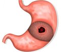 Clinical manifestations and endoscopic and histological changes in children with chronic gastritis, induced by Helicobacter pylori, with different toxicity
