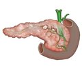 Individual surgical tactics in the treatment of chronic pancreatitis and pancreatic pseudocysts