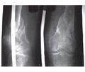 Tactical and technological features of the treatment for damages to the distal metaepiphysis  of the femur