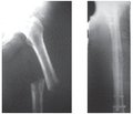Метастазы анонимного рака в длинные кости конечностей: подходы к обследованию  и лечению