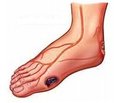 Analysis of negative results of the treatment for diabetic foot syndrome in outpatients