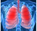 Світовий досвід з лікування інтерстиціальних захворювань легень у дітей (up-date 2017)