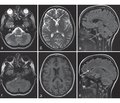 Harding-синдром — наследственная оптическая нейропатия Лебера и рассеянный склероз: клинический случай и обзор литературы