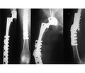 Сучасні тенденції лікування перипротезних переломів стегнової кістки