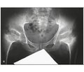 Вплив коморбідності на результати ендопротезування суглобів нижніх кінцівок у хворих з остеоартрозом при спондилоепіфізарній дисплазії
