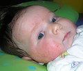 Fermentopatiya as reason of skin manifestations atopy at children